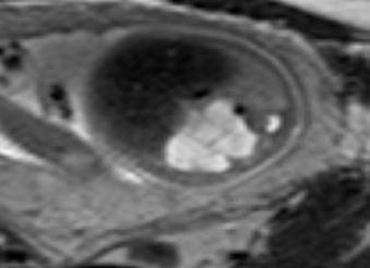 Fetl MR ksiyel plnd T2 ğırlıklı görüntüde sğ kciğerde septlı kongenitl kistik denomtoid mlformsyon ile uyumlu hiperintens lezyon, fetl dönemde lezyon içi sıvı ile dolu olduğundn sıvı sinyli