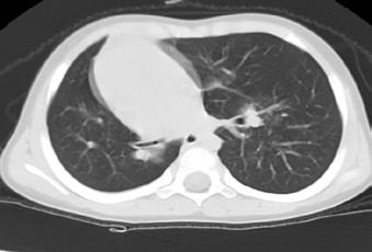 PA grfide sğ kciğer üst ve ort zonu doldurn rdyolusensi görülmektedir. Medistnde hfif sol kym vrdır Resim 17.