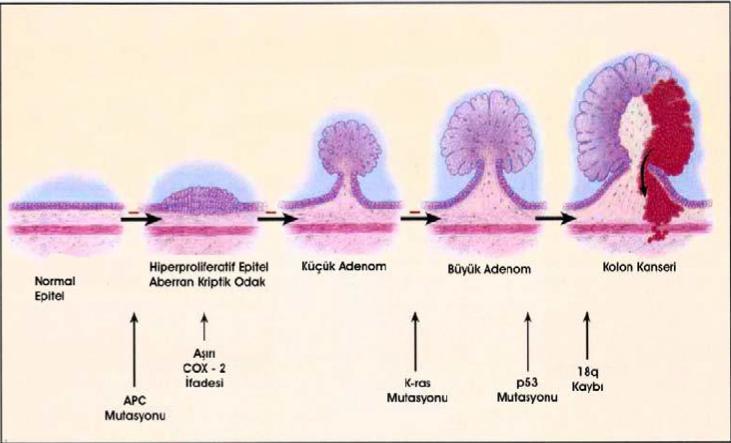 Şekil 2.3. Kolorektal kanser gelişiminde moleküler basamaklar 30 2.8.5.Kromozom 18q Kaybı Kolorektal karsinomda allelik kayıpların en sık gözlendiği bölge 17p den sonra 18q kromozom bölgesidir.