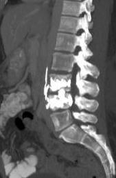 perivertebral venöz pleksus içinde akrilik semente ait