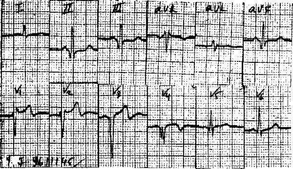 NEŞET A V I AN 35 Sol dal bloku mevcudiyetinde inferior miyokard infarktüsünü teşhis etmek anterior miyokard infarktüsünü teşhis etmekten daha kolaydır. Sol dal blokumla V4.5.6 derivasyonlannda Q dalgasının yeniden teşekkül etmesi anteroseptal miyokard infarktüsünü kuvvetle şüphe ettirir.