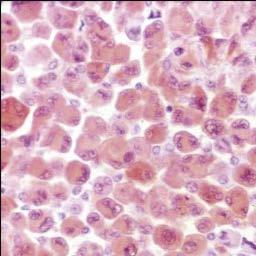 Metastatik malign melanoma Bilateral Pigment yardımcı olabilir HMB45 (+), S100 (+)- -- Melan A sex-cord