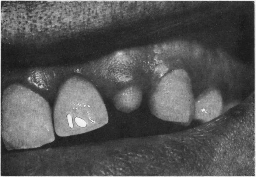 AŞIRI KENAR EĞİMLİ PREPARASYONDA RESTORASYON Resim 1 : Hatalı preparasyon yapılmış sol üst lateral diş.