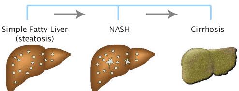 Nonalkolik yağlı karaciğer Nonalkolik steatohepatit NAYK NASH Siroz Belirgin inflamasyon olmadan hepatik