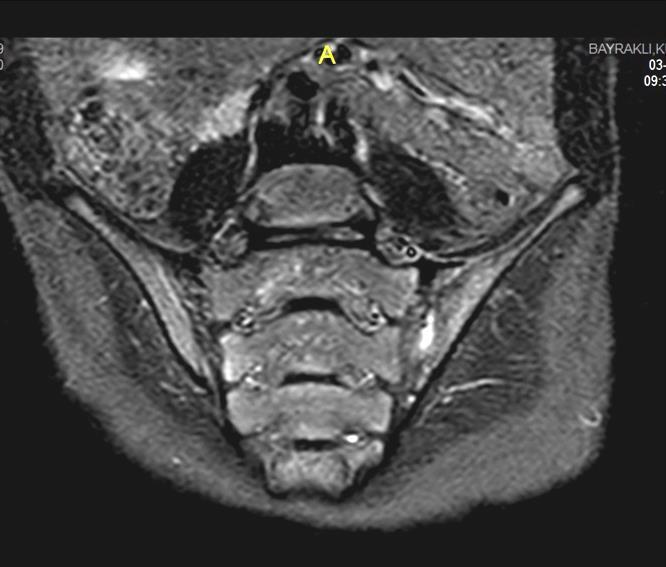 Kalça ve Sakroiliak MR (26.03.