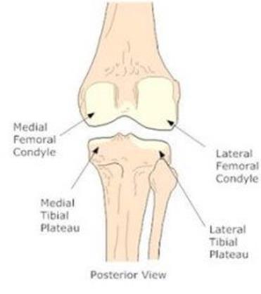 Medial plato kırıkları genellikle yüksek enerjili yaralanmalarla ortaya çıkar ve tek parçadır.