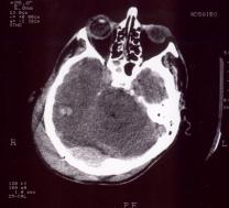 Travmatik Posterior Fossa Epidural Hematomları Bu 3 olgunun 2 sinde bilinç seviyesinde gerileme varken, 1 inde bilinç seviyesi ve nörolojik tablosunda değişiklik yoktu.