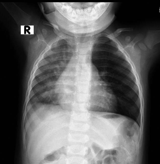 (30) bronkoskopide yabancı cisim tespit edilen hastalarda akciğer grafisinde amfizem bulgusunun daha yaygın olduğunu, negatif bronkoskopilerde pnömoni ve atelektazi bulgularının daha yaygın olduğunu,