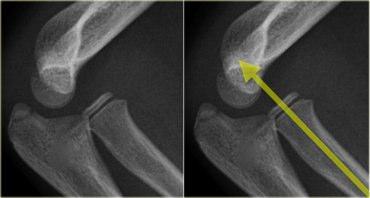 femur fraktürü ( salter tip2) Ayak parmağı proximal phalanx