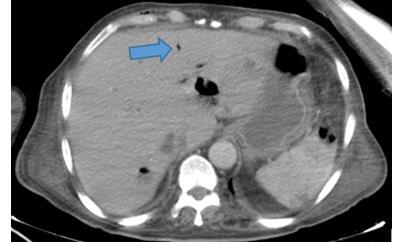 Abdominal BT Operasyona sekonder