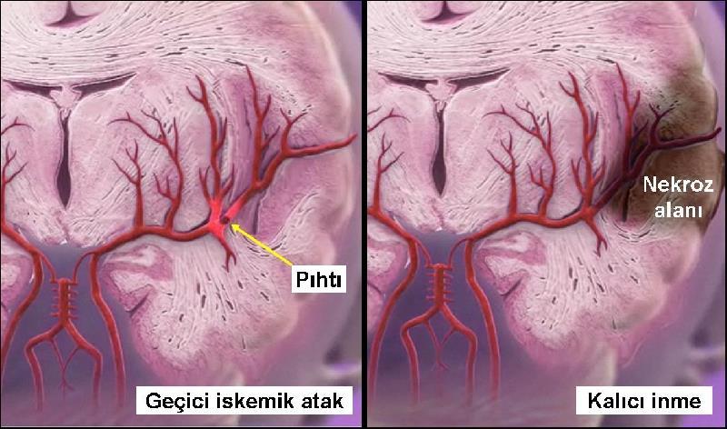 değişiklikler, arterit, anevrizmal dilatasyon ve gelişimsel malformasyonlar gibi durumlarda da gelişebilir (1).