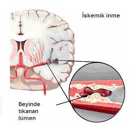 İSKEMİK İNME İskemik inme serebral kan akımının azalması veya nöronal elemanlar için gerekli olan oksijen ile glikozun belirli değerlerin altına düşmesi ve bu durumun belli bir süreden fazla devam