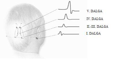 dalgalar aşağı beyin sapından, IV. ve V.dalgalar yukarı beyin sapından köken almaktadır şeklinde özetlenebilir (Şekil 2.9). Şekil 2.9. ABR Dalgaları 2.3.