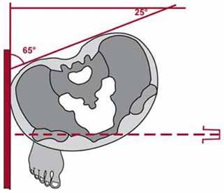 Pediatrik kalça sorunlarında görüntüleme yöntemleri 393 Şekil 4. ACM açısı, CE açısı, MZ mesafesi. [3] Tablo 3. Normal merkez kenar (CE) açısı değerleri Yaş CE açısı 5 8 yaş 19 Şekil 5.