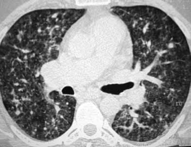 Pathologies Y. Altemur Karamustafaoğlu ve ark.; Edirne, Türkiye Sayfa-Page: 159 Kronik Akciğer Hastalıklarında BNP Düzeyi BNP Levels in Chronic Pulmonary Diseases Gülfer Okumuş ve ark.