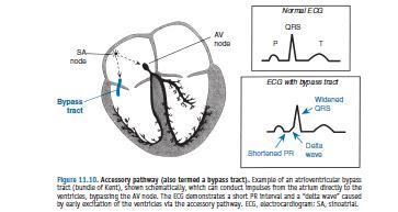Preeksitasyon sendromu: WPW send Uyarıların Atriyumdan ventriküle bypass
