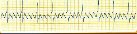 ATRıAL FLUTTER Düzenli bir atriyal aritmi olup atriyum hızı 250-350/dakika arasındadır. Yüksek hızlı atriyal defleksiyonlar EKG'de testere dişi görünümüne yol açar.