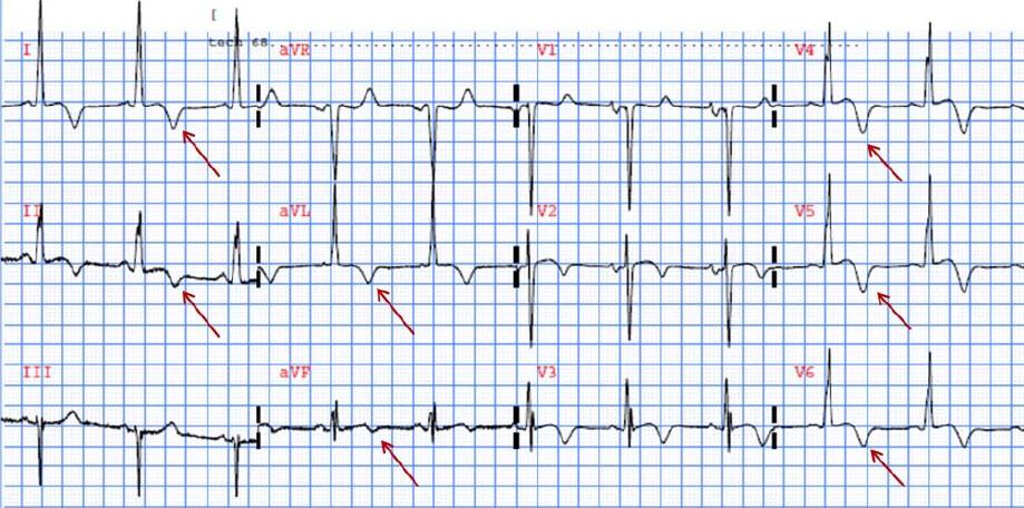 İnferolateral derin (-) T dalgaları; EKO