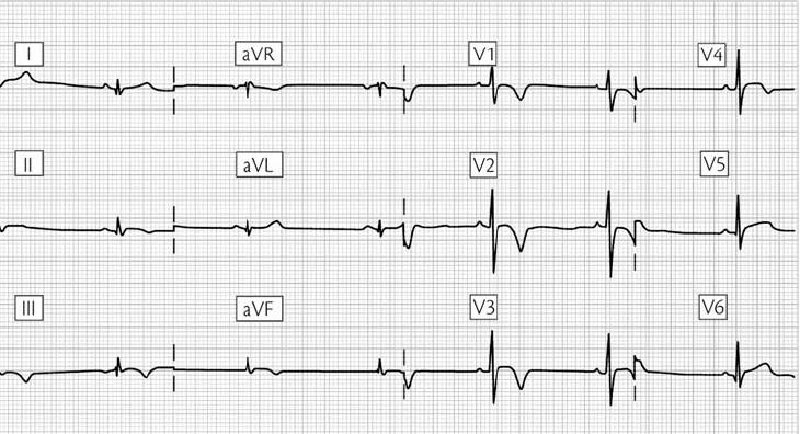 İnferior ve anteroseptal leadlerde T(-), extremite