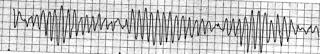 Monomorfik VT Eş biçimli QRS ler