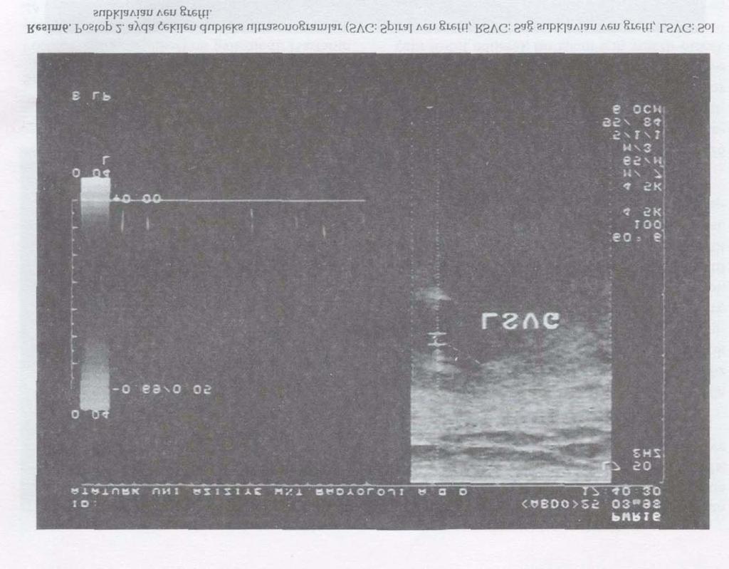 GKDC Dergisi 1998:6: 258-262 Kaynaklar 1. Rutherford RB; Vascular Surgery. Philedelphia WB Saunders Co. p 387:1995. 2. Moore WM, Hollier LH, Pickett TK.