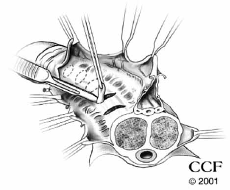 Derleme ERKEK CİNSEL SAĞLIĞI sı arasındaki planda ventrolateralden başlanıp orta hatta doğru ilerlenerek diseke edilip eleve edilirek korpus kavernozumun dorsolateral kısmını ortaya koymak için