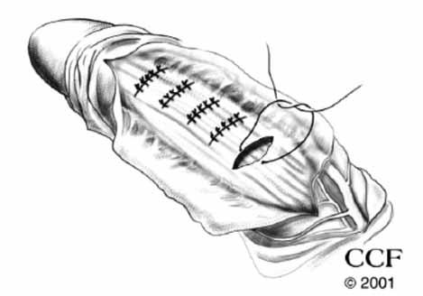 İlgili alanındaki tunika albuginea ortaya konulduktan sonra altındaki erektil dokular dikkatle korunarak, tunikadan enine odaklı elips şeklinde eksizyonlar yapılır.