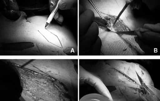 ERKEK CİNSEL SAĞLIĞI Derleme Şekil 16: Donörün sağda kılsız ingüinal cildinden alınacak olan dermal greft yeri. (B) Epidermis dermis in situ dan keskin diseksiyonla ayrılır.