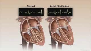 Atrial Fibrilasyonun Patofizyolojisi AF; atrial dokuda Anormal impuls