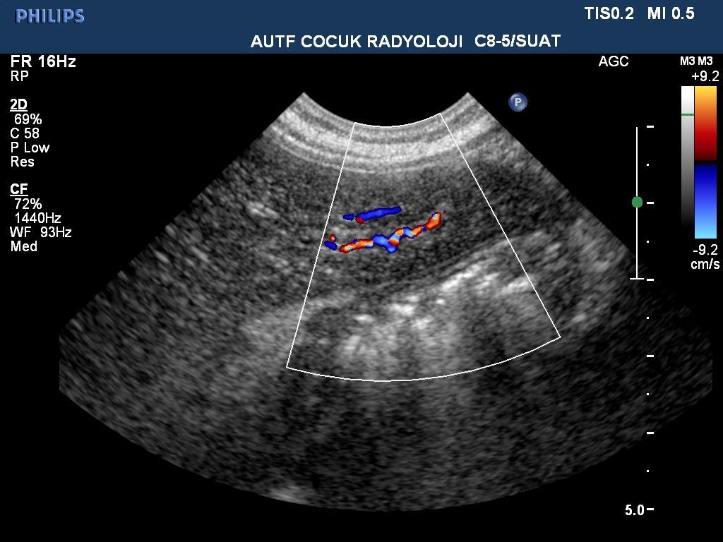 Hepatik arterde