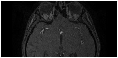 görüntüde anterior komunikan arter anevrizmasına eģlik eden