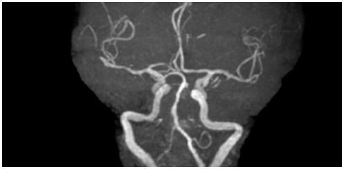 intensity projeksiyon görüntüde sol posterior serebral