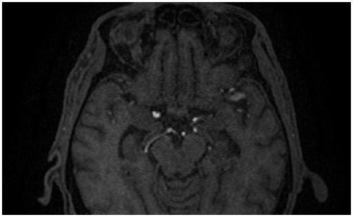 maksimum intensity projeksiyon görüntüde eģlik eden sağ fetal posterior serebral arter