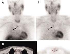 [99mTc]MIBI scintigraphy ile belirlenmiş