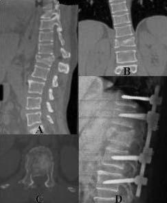 Şekil 2: L 1 omurgasında patlama kırığı olan hastanın radyolojik inceleme görüntüleri, A, B: BT sagittal ve koronal planda üst son plak hasarı ve cisim yükseklik kaybı, C: BT aksiyal planda orta