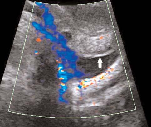 Gerçek zamanl transvajinal Doppler ultrasonografi esnas nda over kist rüptürü geliflimi takdim edilmifltir. Ultrasonografik muayene esnas ndaki renkli Doppler bulgular da kaydedilmifltir.