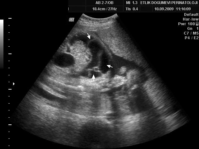 K ykaç Alt nbafl fi ve ark. merkezden fetal abdominal asit ön tan s yla klini imize refere edildi.