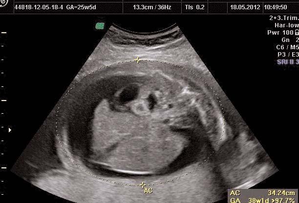 prenatal dönemde KKAM için ultrasonografinin duyarl l n %81 ve pozitif prediktif de erini %57 olarak bildirmifllerdir.