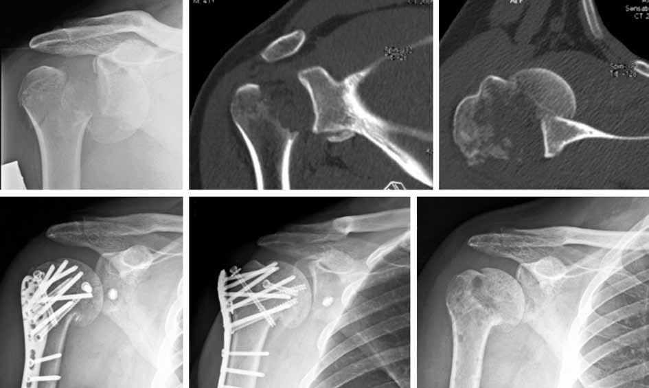 Aksu ve ark. Kilitli plak ile tedavi edilen proksimal humerus kırıklarında görülen komplikasyonlar 93 (a) (b) (c) (d) Şekil 4.