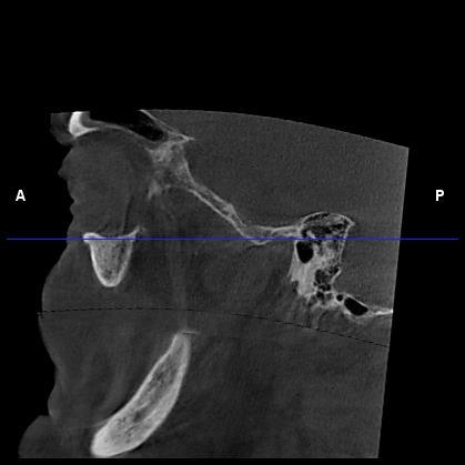 36 a. Sagittal görüntüler üzerinde Frankfurt horizontal düzlemi yer düzlemine paralel hale getirildi (Resim 3.1)