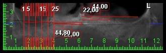 37 Panoramik görüntüler üzerinde birinci premolar insisiv foramen arası erkek hastalar için ortalama mesafe 22 mm. ve ikinci molar insisiv foramen arası mesafe 44,95 mm. olarak belirlendi.