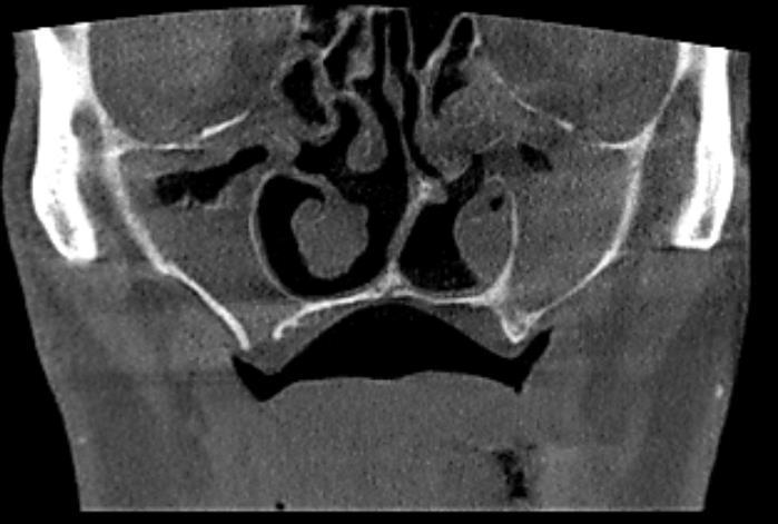 41 Resim 3.11. Konik ıģınlı bilgisayarlı tomografi koronal kesitte izlenen sinonazal polipozis görüntüsü 3.5.
