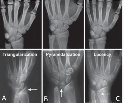 Madelung tanımını distal ulnanın öne spontan subluksasyonu şeklinde yapmıştır (Binder, 2011). Radyolojik tanımlama ilk olarak Langer tarafından gerçekleştirilmiştir.