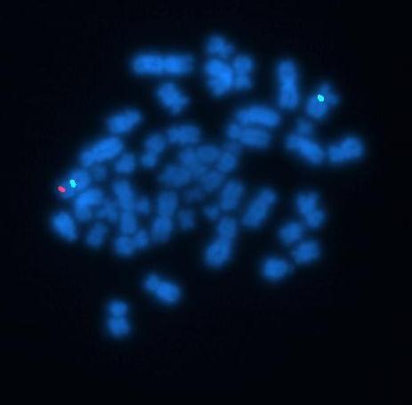 Şekil 4.7. Olgu 12 ye ait FISH görüntüsü. 1K, 2M sinyal kız için heterozigot SHOX geni delesyonu anlamına gelmektedir. Delesyon saptanmayan diğer 37 olguda dizi analizi gerçekleştirilmiştir.