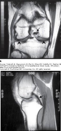 Kas yırtığı, tendon veya bağ kopmaları, sinir hasarı, kanama,