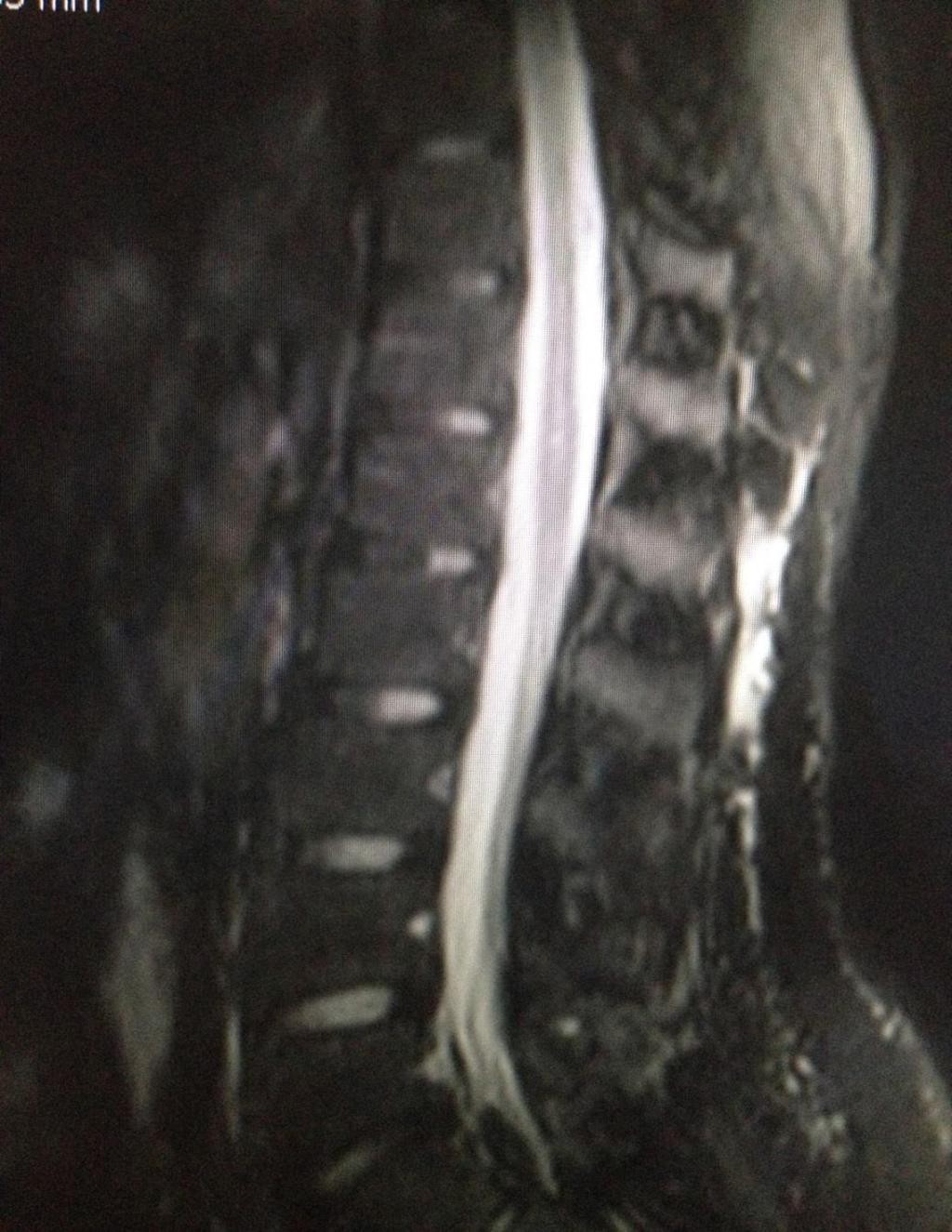 SERVİKAL, TORAKAL, LUMBAL SPİNAL MR (25/03/2013) T12-L1 seviyesinde konus düzeyinde medulla spinaliste sagittal T2A ve STIR