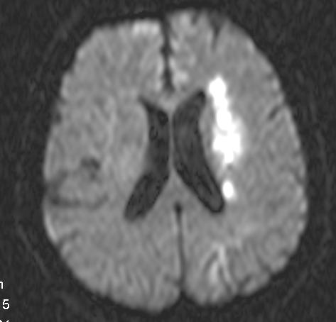 Unilateral multiple ön