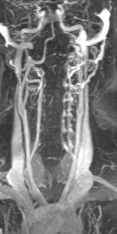 sol vertebral arterde diseksiyon ile