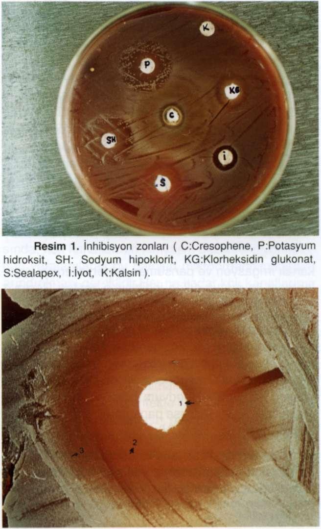 Aydemir H, Balkaya B, Demirel S özellikleri tam olarak taşıyan materyaller henüz olmamasına rağmen, ideale en yakın olanları tercih edilmektedir.