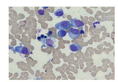 Plazma Hücreli Lösemi Periferik kandaki plazma hücrelerinin % 20 den ve/veya 2 x 10 5 /l den fazla
